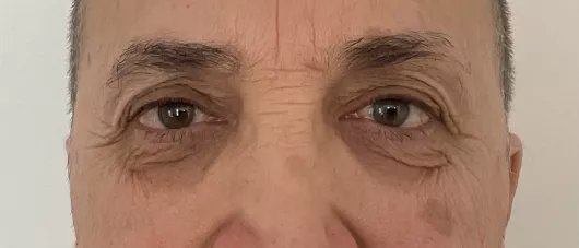 BLEPHAROPLASTIE SUPERIEURE ET INFERIEURE