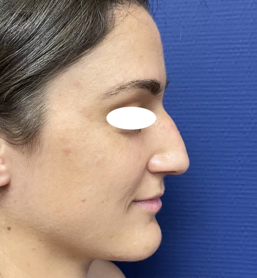 Rhinoplastie réalisée à Marseille