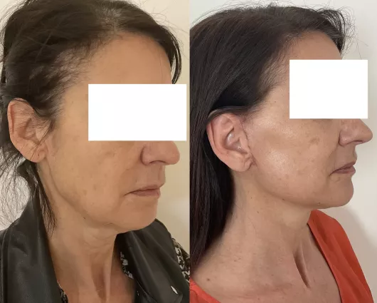 lifting cervico facial marseille