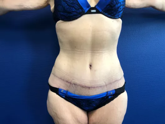 abdominoplastie marseille