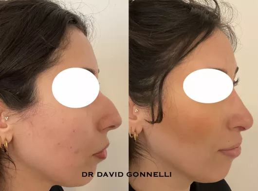 rhinoplastie avant apres