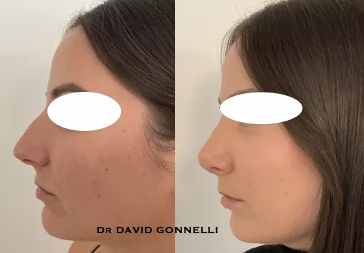 RHINOPLASTIE à Marseille