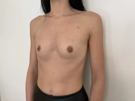 Augmentation mammaire par prothèses rondes ergonomiques