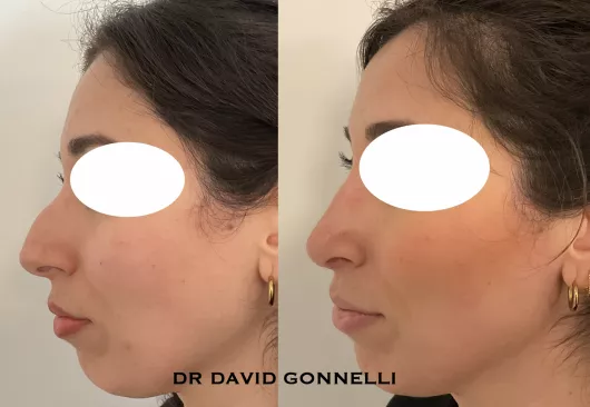 rhinoplastie avant apres