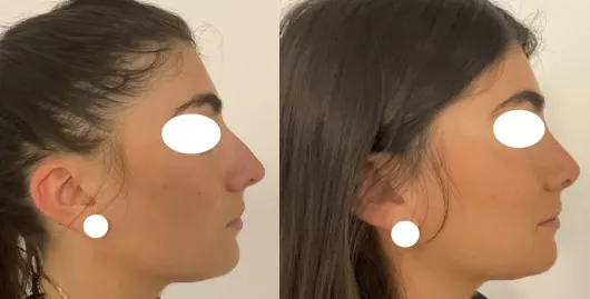 Rhinoplastie