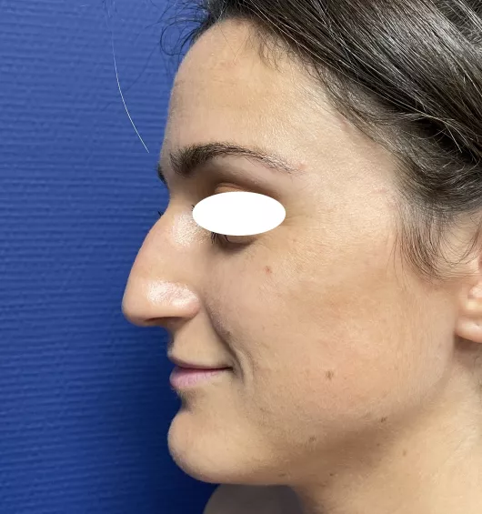 Rhinoplastie réalisée à Marseille