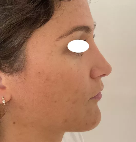 Rhinoplastie réalisée à Marseille