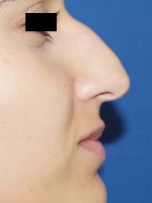 rhinoplastie marseille