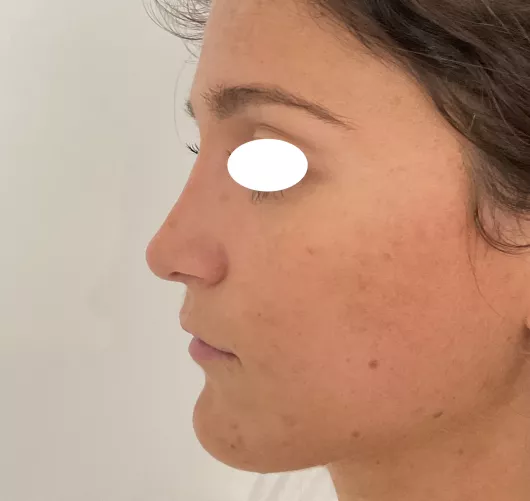 Rhinoplastie réalisée à Marseille