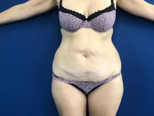 Abdominoplastie post grossesse