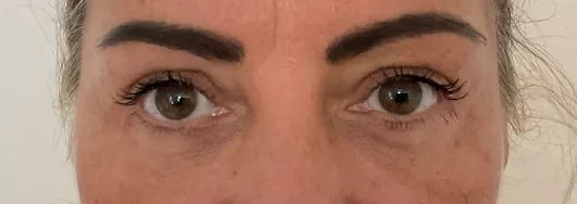 Blepharoplastie supérieure et inférieure