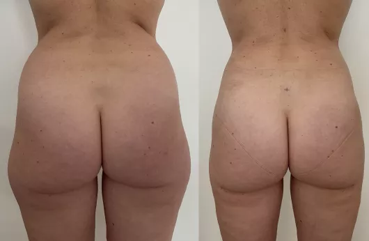 LIPOSUCCION VASER HD