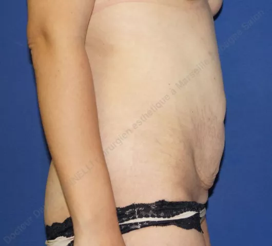 abdominoplastie tarif