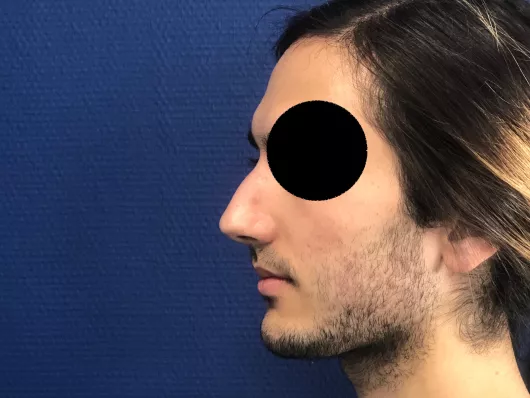 rhinoplastie avant après