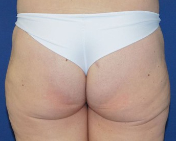 Chirurgie des Fesses Marseille Aubagne