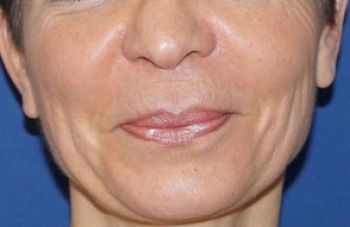 lipofilling visage marseille
