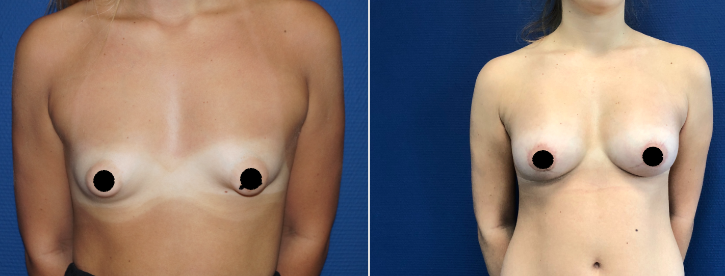 Les différentes opérations pour les seins tubéreux