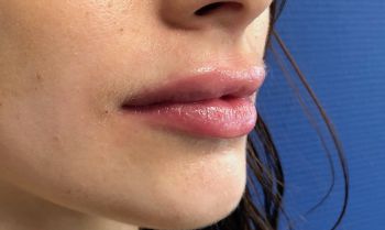 augmentation lèvres marseille